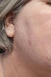 Customer photo review of FaceSilk™ Hair Removal Spray