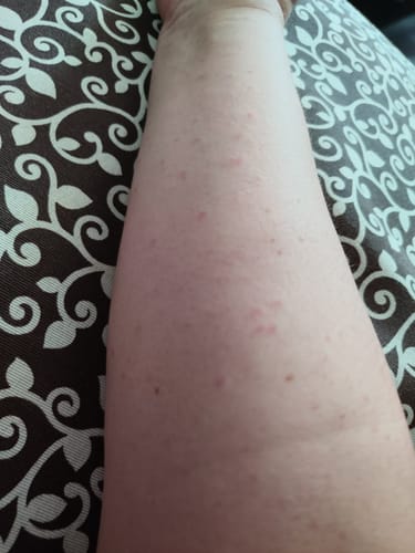 Customer's arm showing red, irritated skin spots before using Sereni Pikkelysömör és Ekcéma Krém.