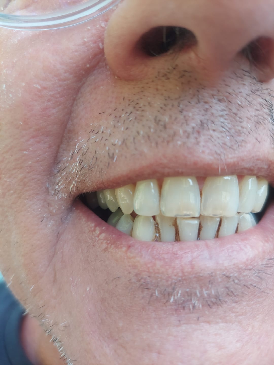 Customer photo review of Composite Care Bundle