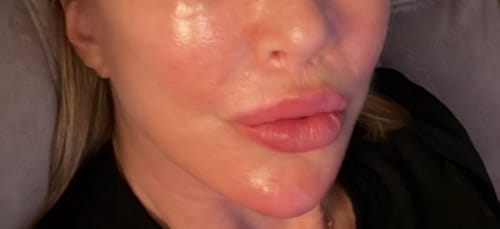 Customer's face showing glowing skin after using the Micro Infusion System treatment.