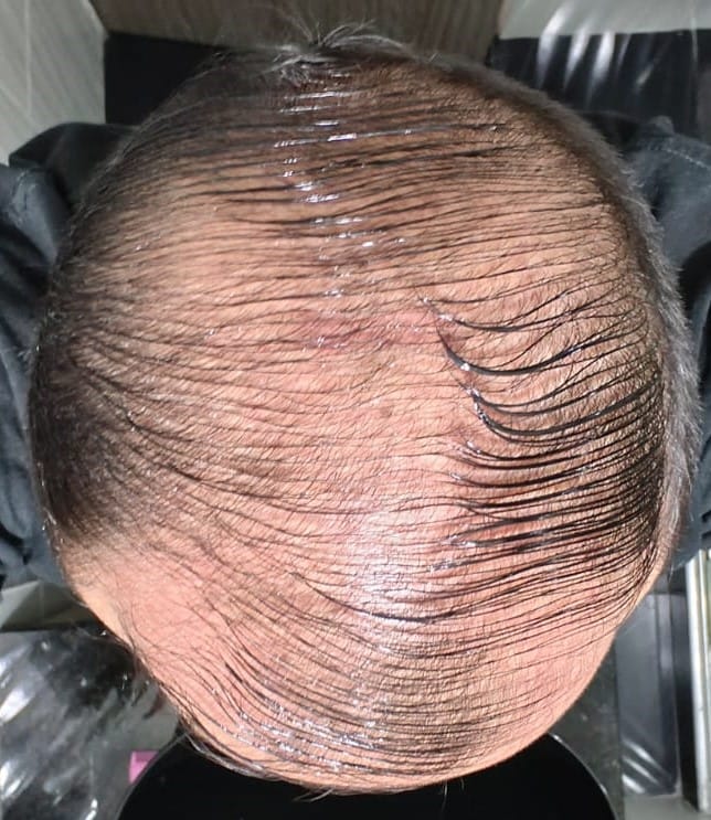Customer photo review of 3 Tónicos Capilares de Romero · Crecimiento y Anticaída + Dermaroller de regalo