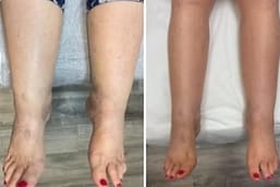 Customer photo review of DRAINANT LYMPHATIQUE LYMÉVIA®