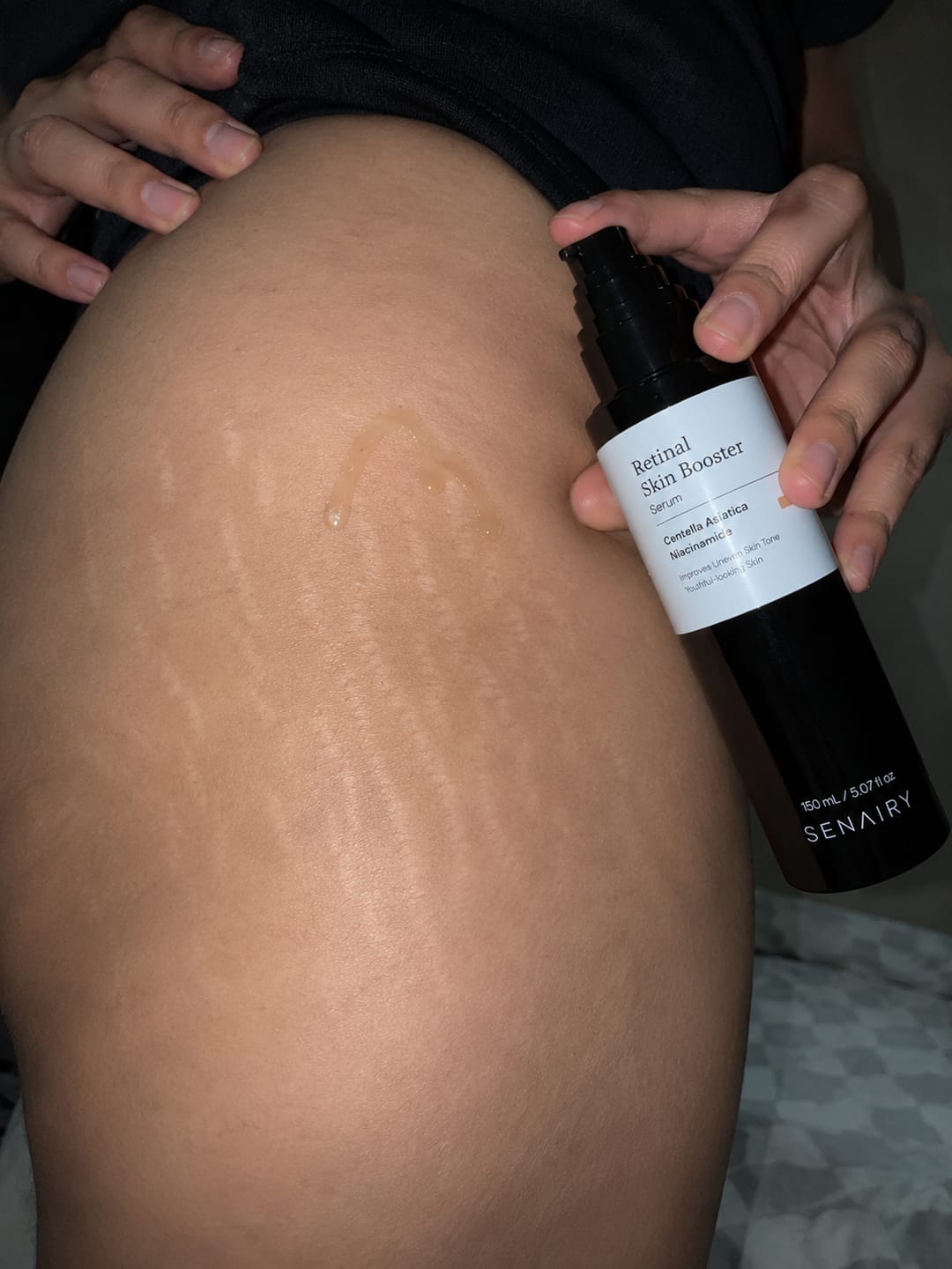 Customer photo review of Senairy Retinal Stretch Mark Serum