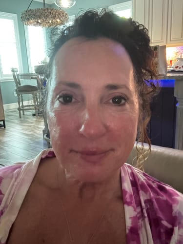 Customer's face showing skin after using the Seranova Micro Infusion System.