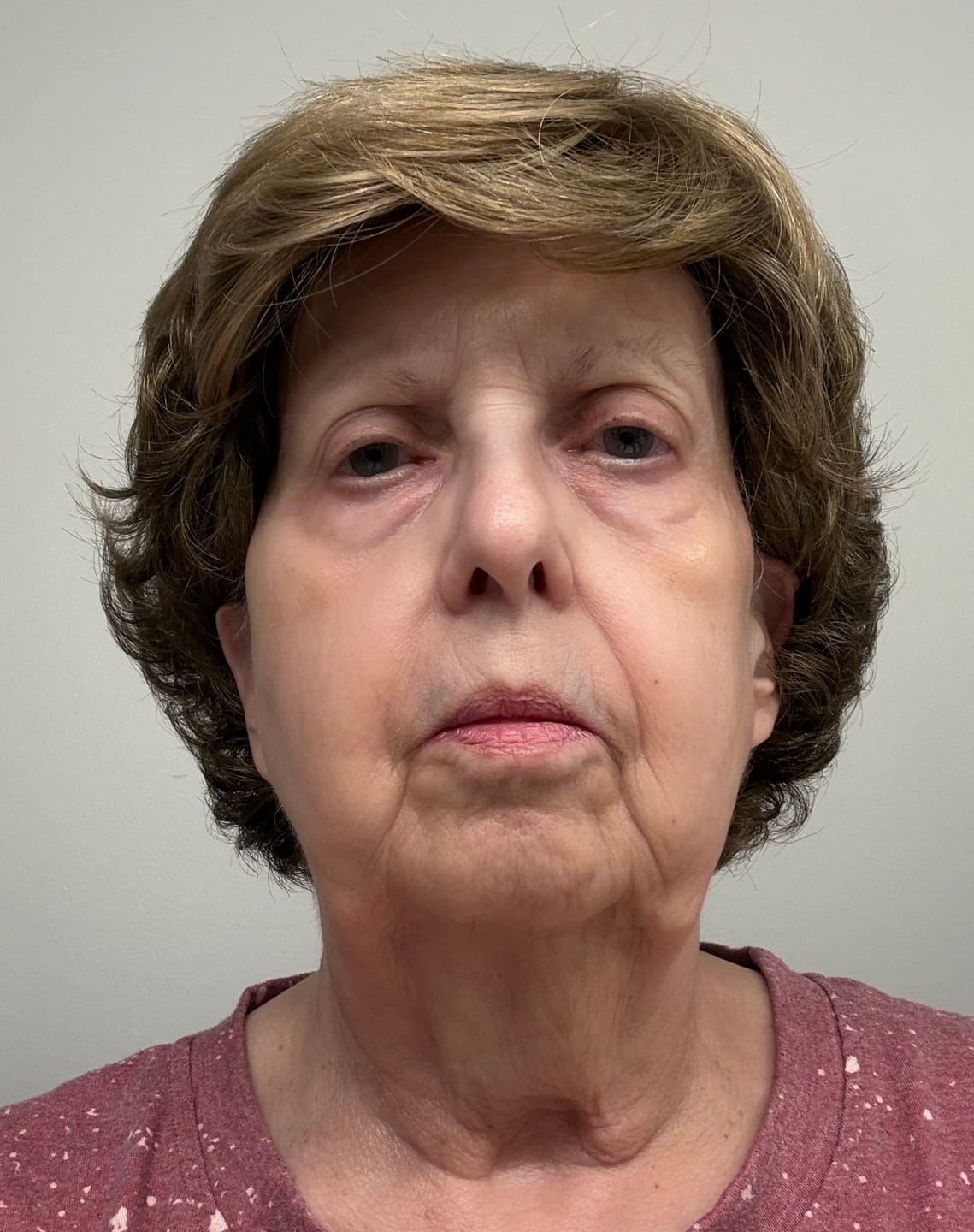 Customer photo review of Collagen Mask