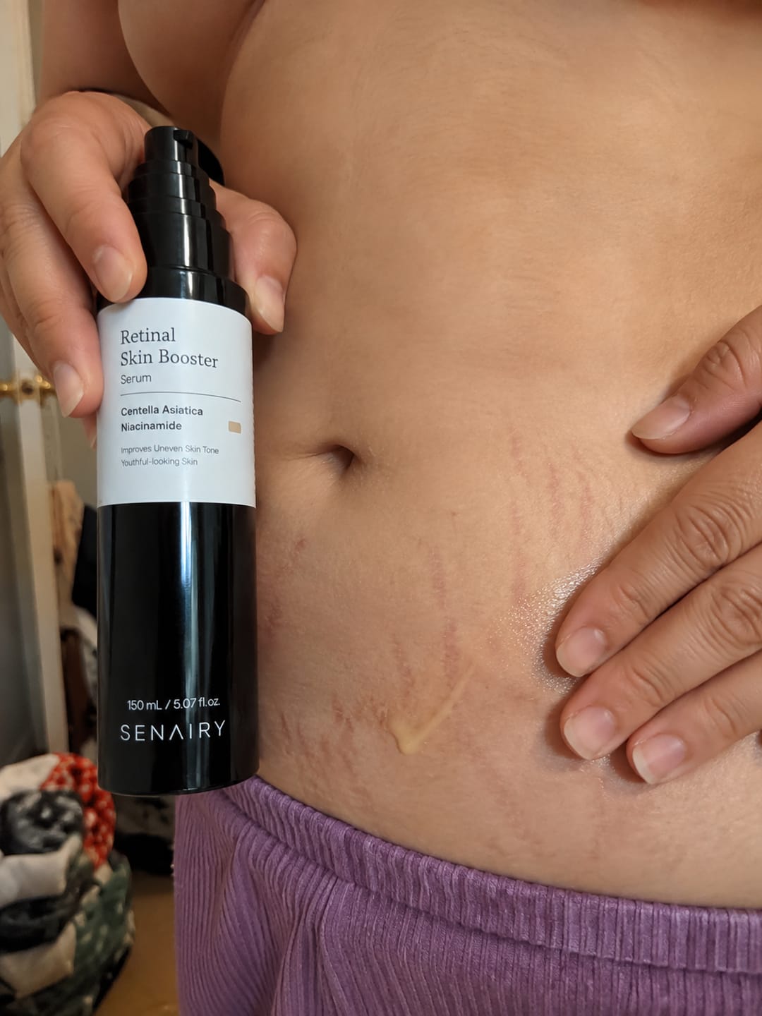 Customer photo review of Senairy Retinal Stretch Mark Serum