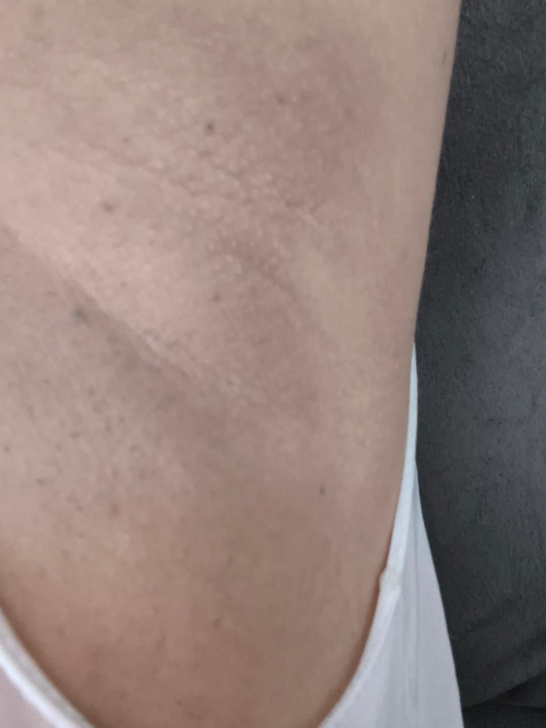 Customer photo review of Creme Clareador de Manchas – Melasma, Axilas, Virilha, Áreas Íntimas, Rosto e Corpo