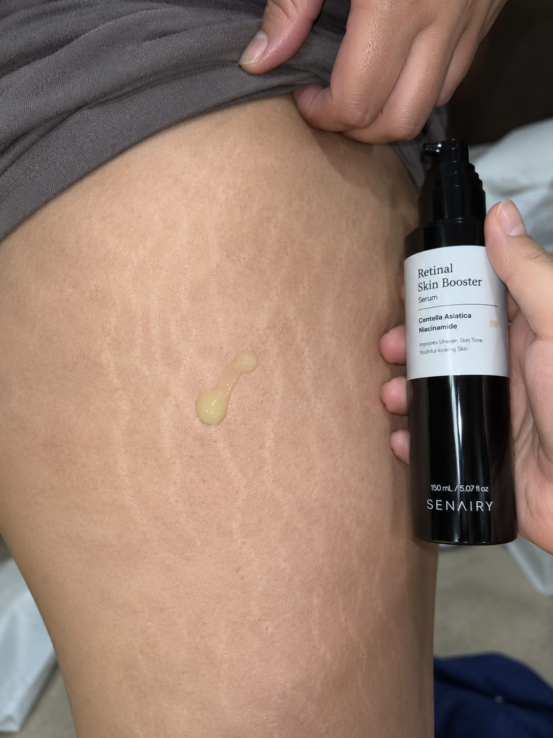 Customer photo review of Senairy Retinal Stretch Mark Serum