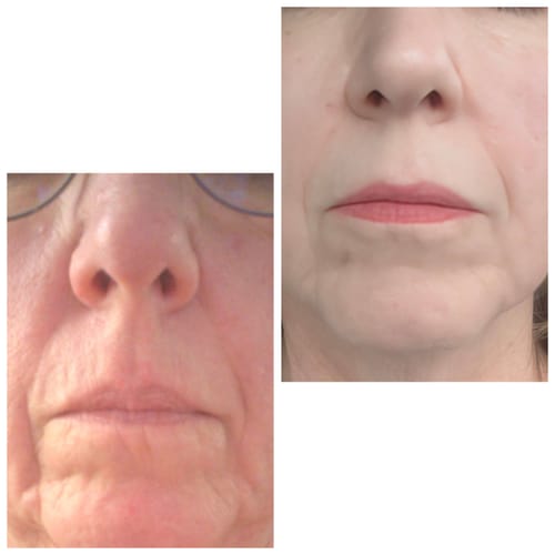 Customer's before and after comparison of skin texture and wrinkles while using the Seranova Micro Infusion System.