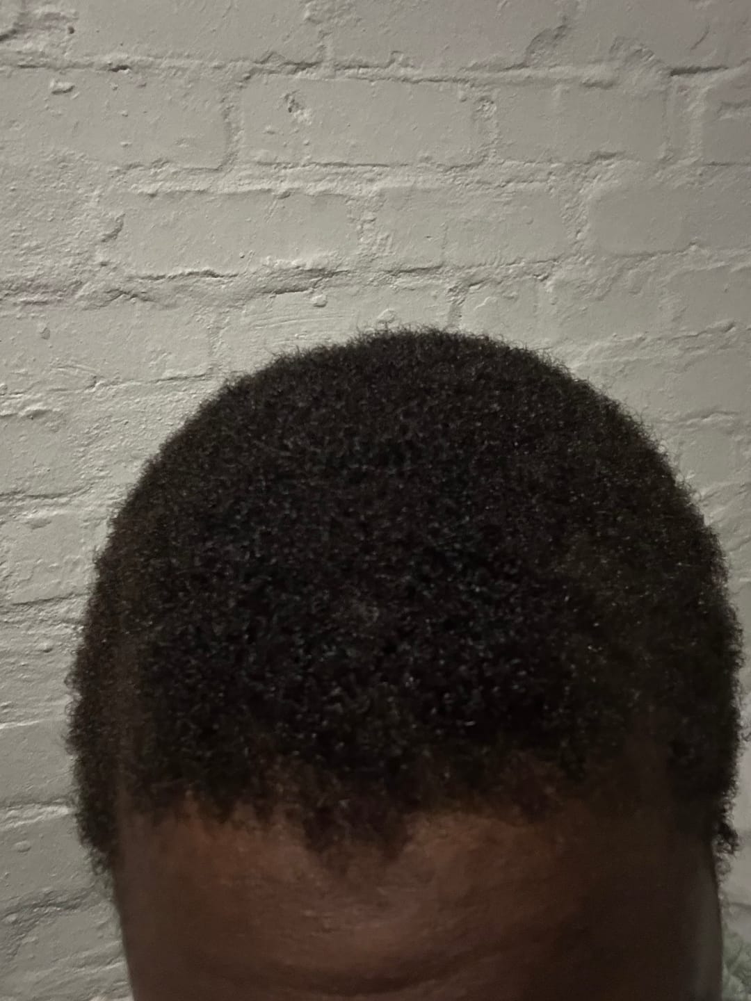 Customer photo review of Minoxidil 5% + DHT Blocker Solution - MEN ONLY, 3 Month supply