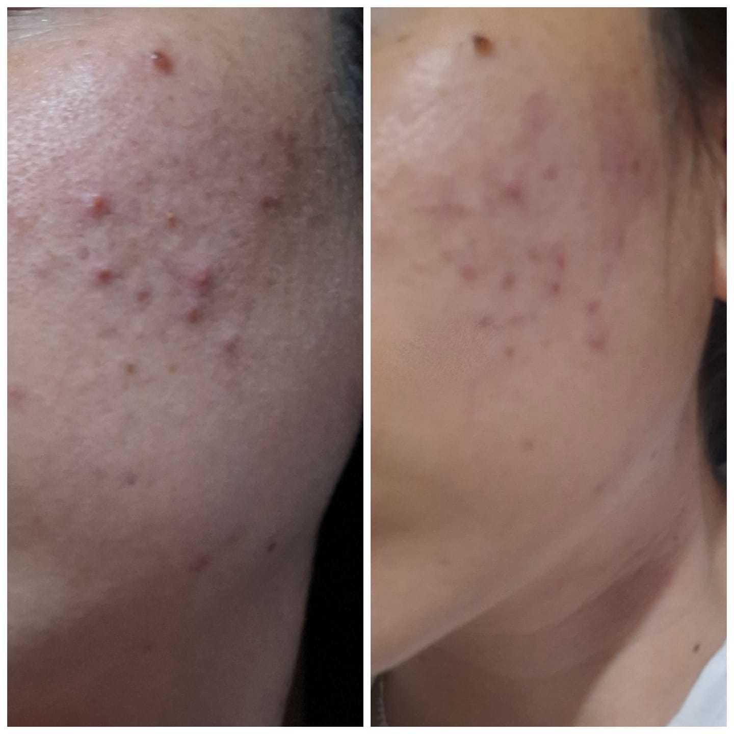 Customer photo review of 377 VC Crema Blanqueadora y Antimanchas