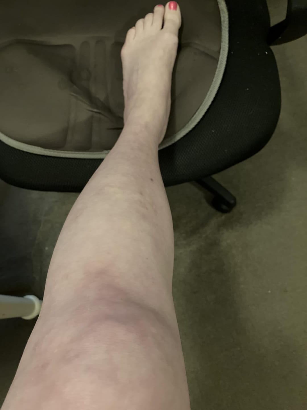 Customer photo review of Flatter, Smoother, Calmer Scars in as Little as 3 Days