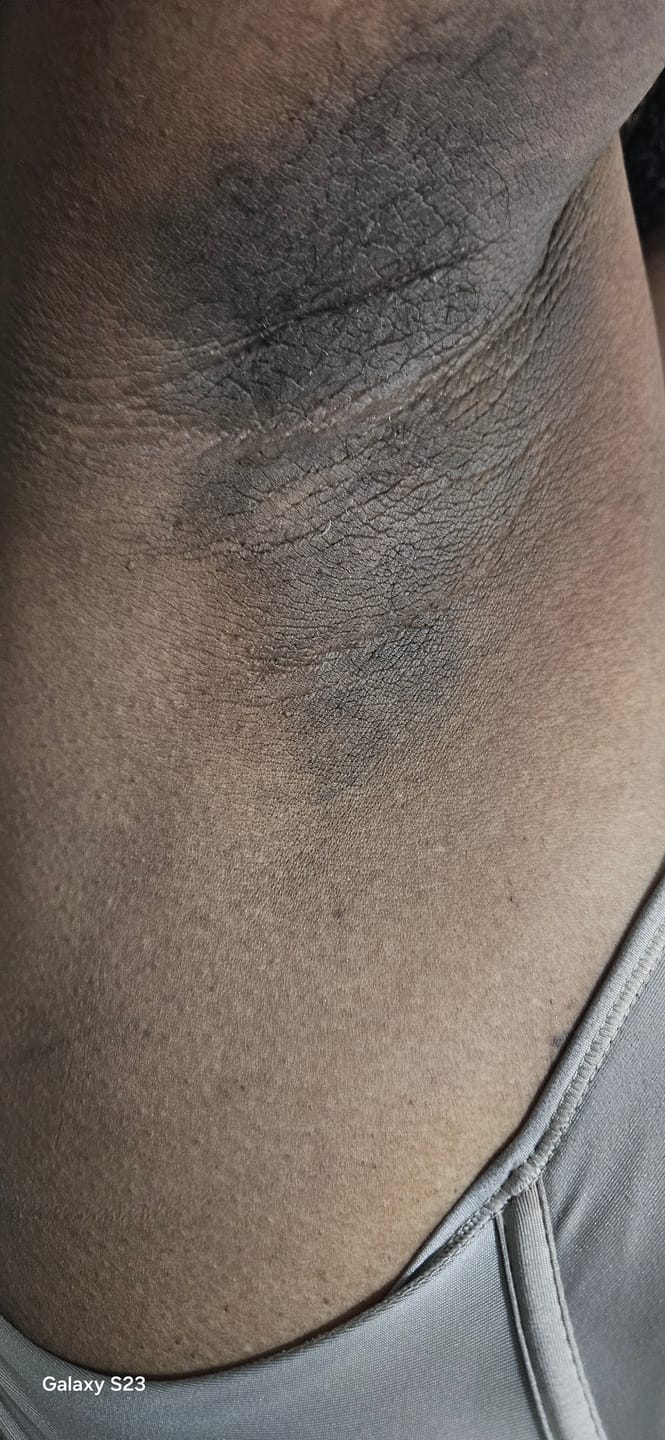 Customer photo review of Creme Clareador de Manchas – Melasma, Axilas, Virilha, Áreas Íntimas, Rosto e Corpo