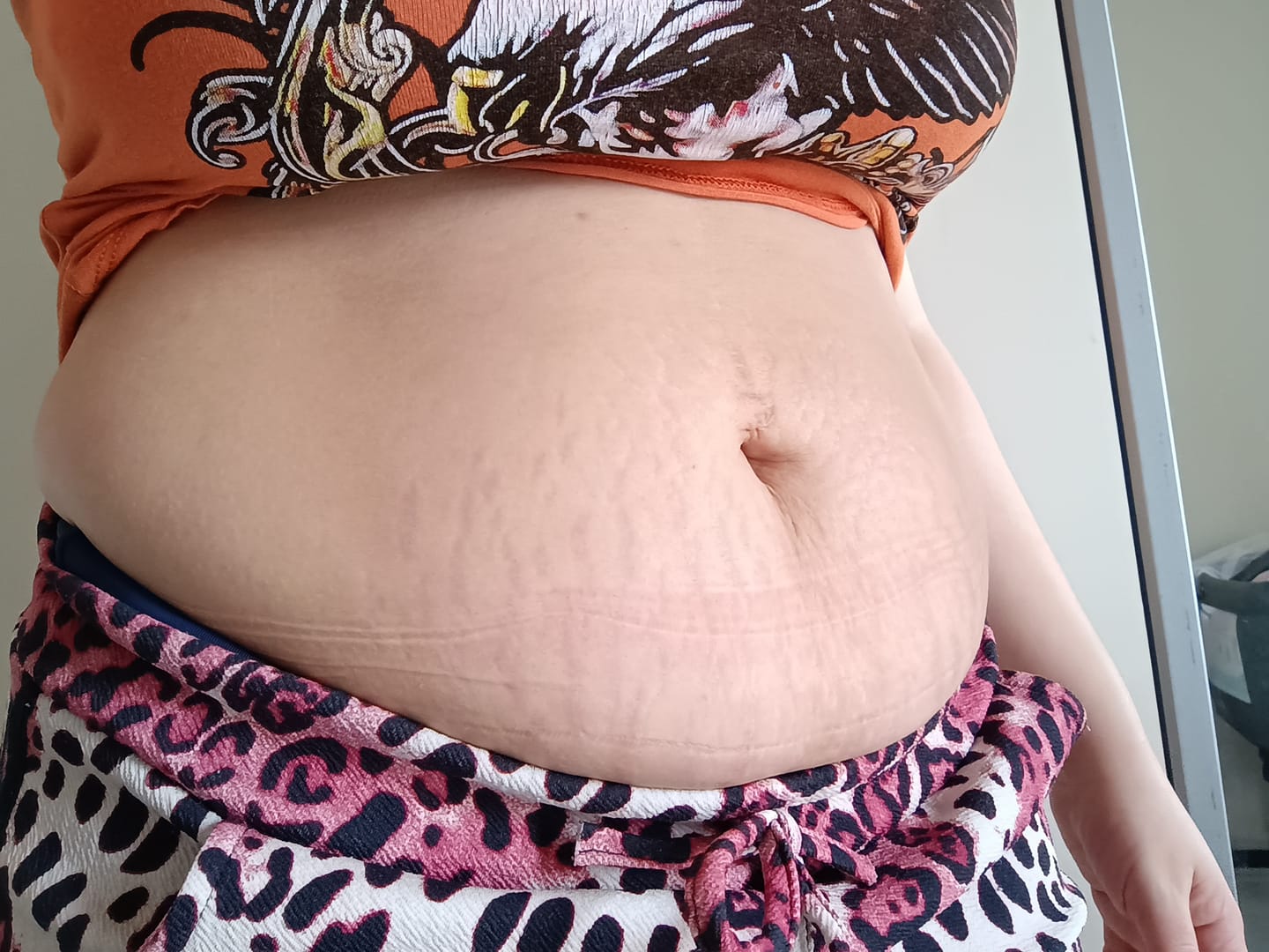 Customer photo review of Creme Antiestrias Regenerador Dérmico