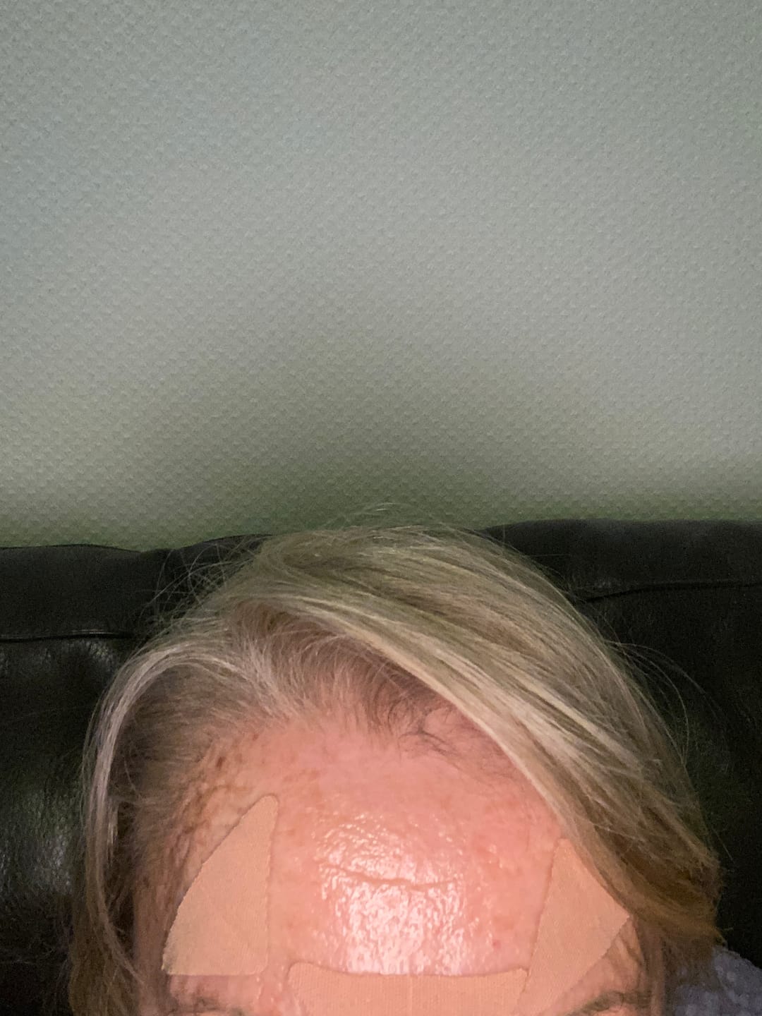 Customer photo review of Zornesfalten Patches mit Hyaluron