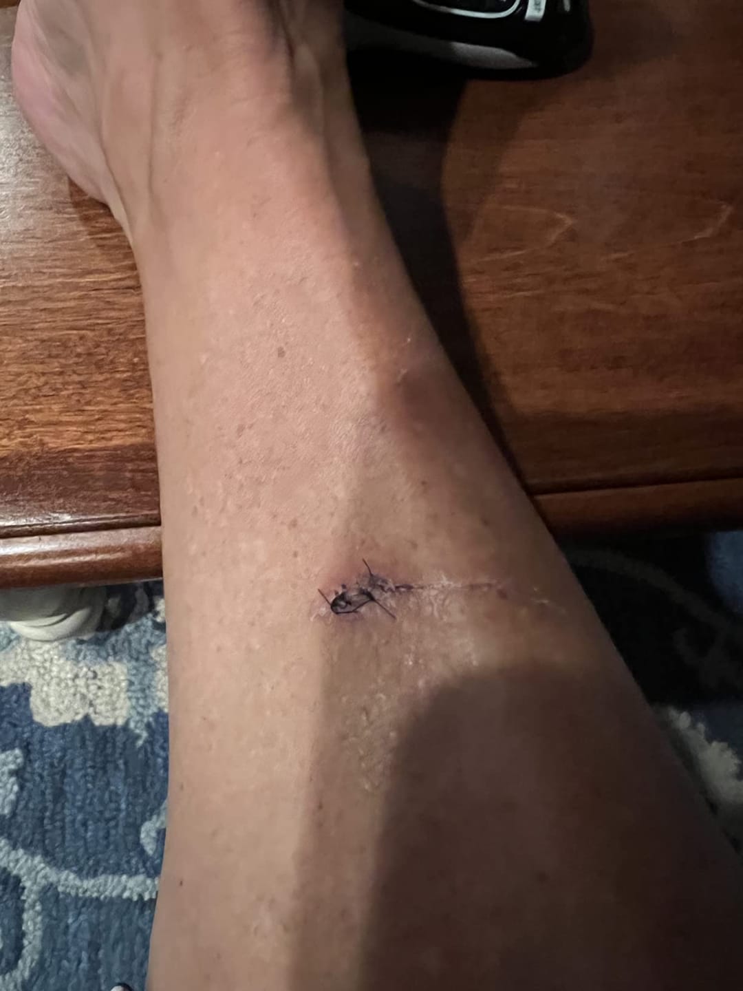 Customer photo review of Flatter, Smoother, Calmer Scars in as Little as 3 Days
