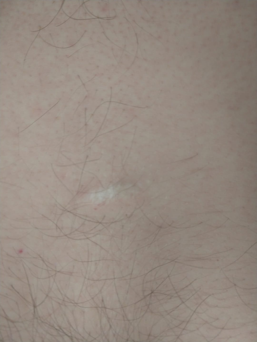 Customer photo review of Flatter, Smoother, Calmer Scars in as Little as 3 Days