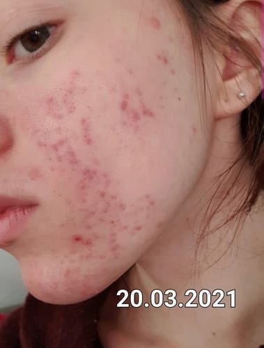 Customer photo review of Pickel & Mitesser Skin Liquid