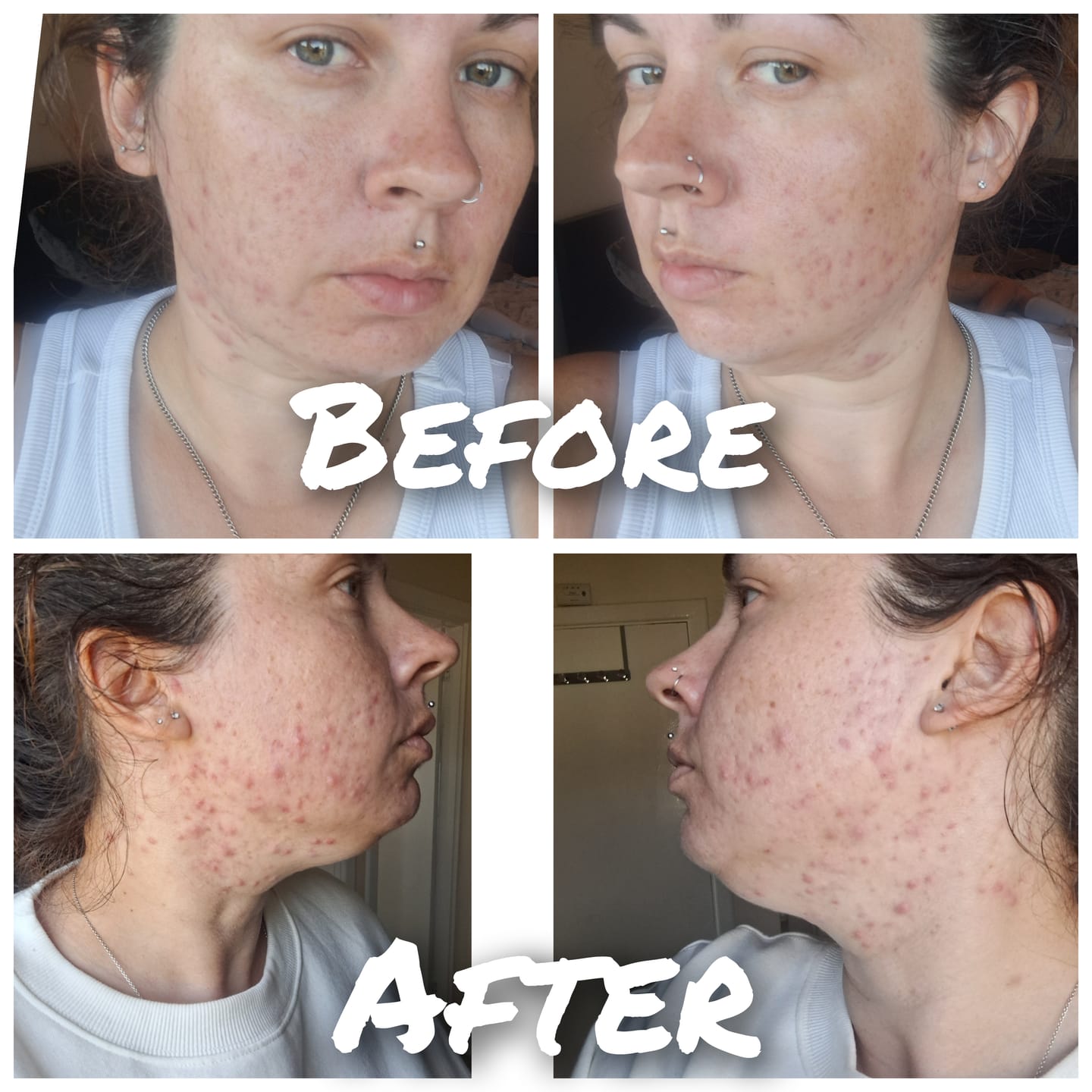Customer photo review of Kill Acne & Redness Ritual