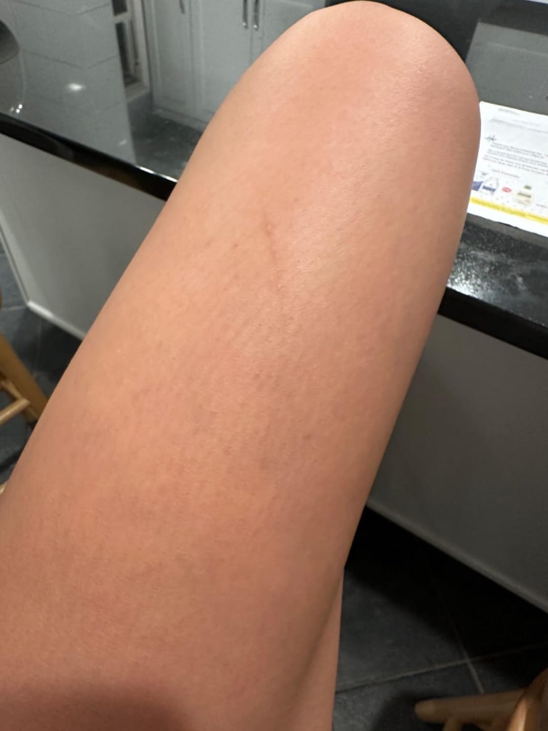 Customer photo review of Flatter, Smoother, Calmer Scars in as Little as 3 Days