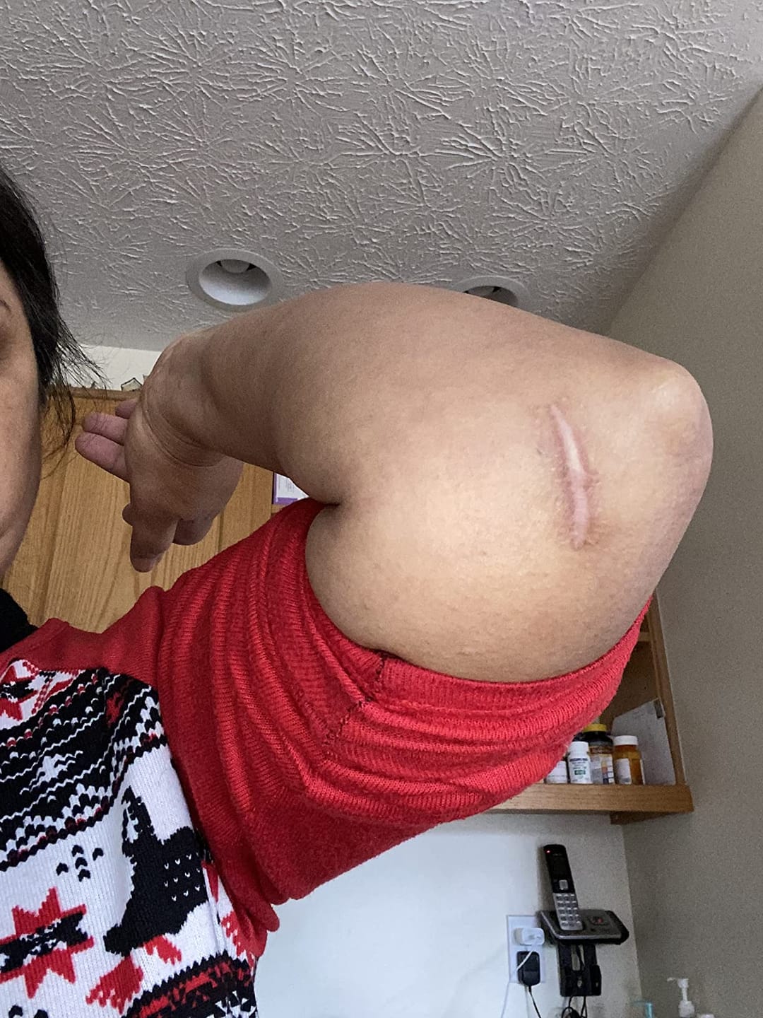 Customer photo review of Flatter, Smoother, Calmer Scars in as Little as 3 Days