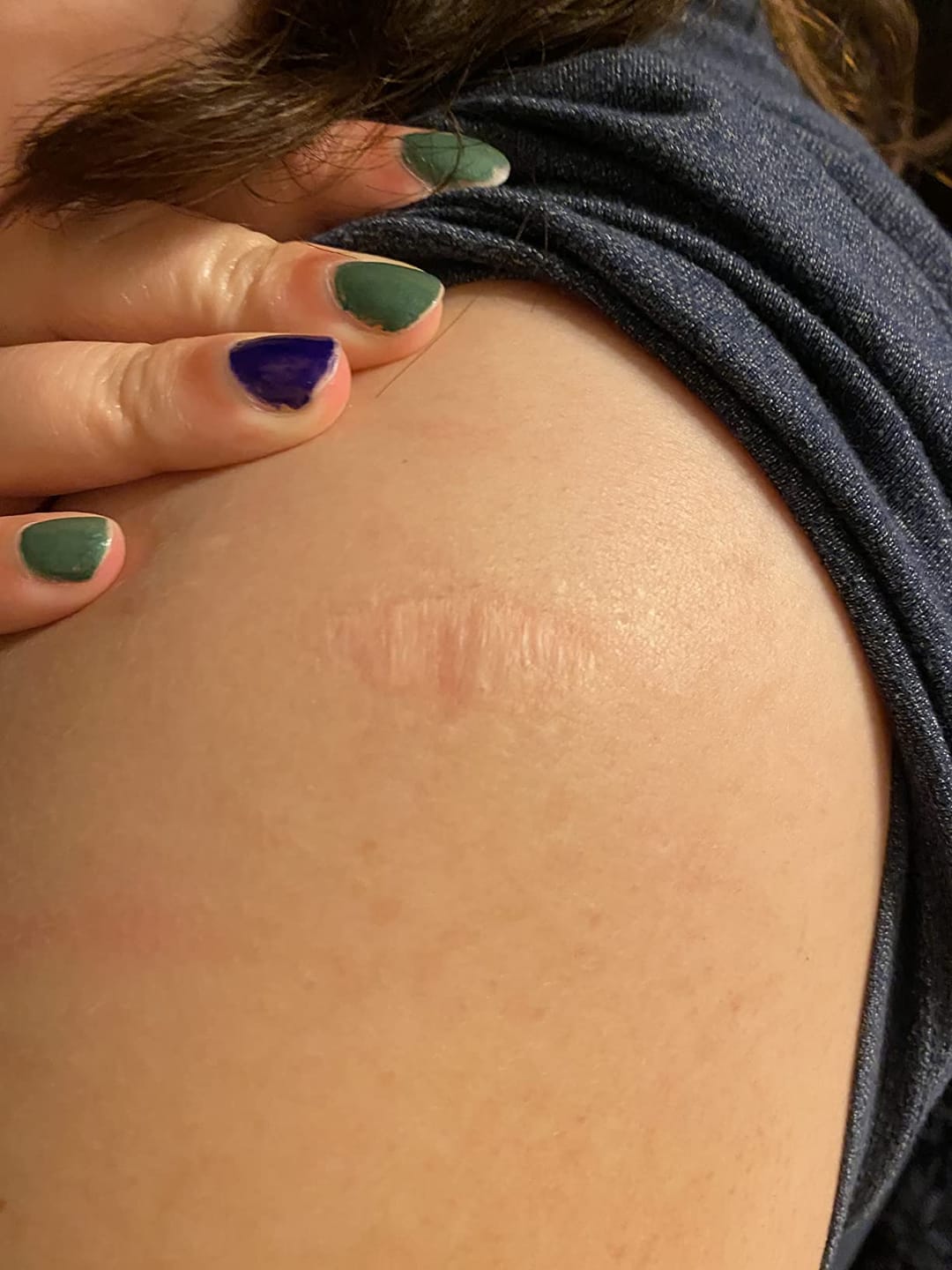 Customer photo review of Flatter, Smoother, Calmer Scars in as Little as 3 Days