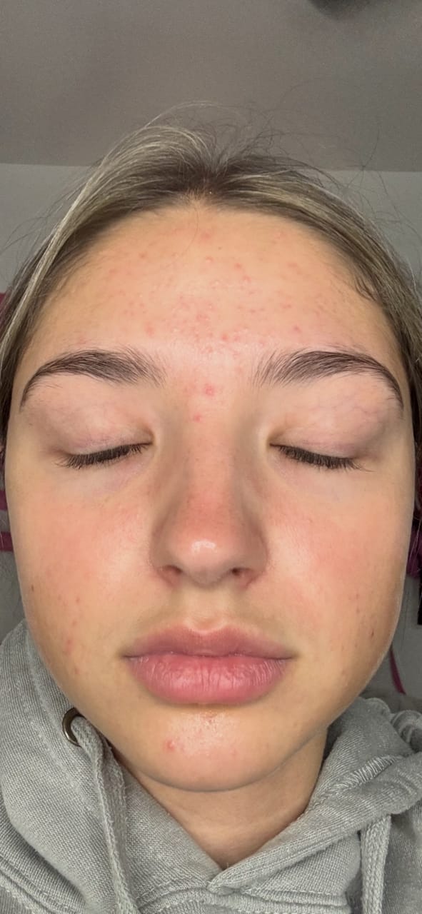 Customer photo review of Kill Acne & Redness Ritual