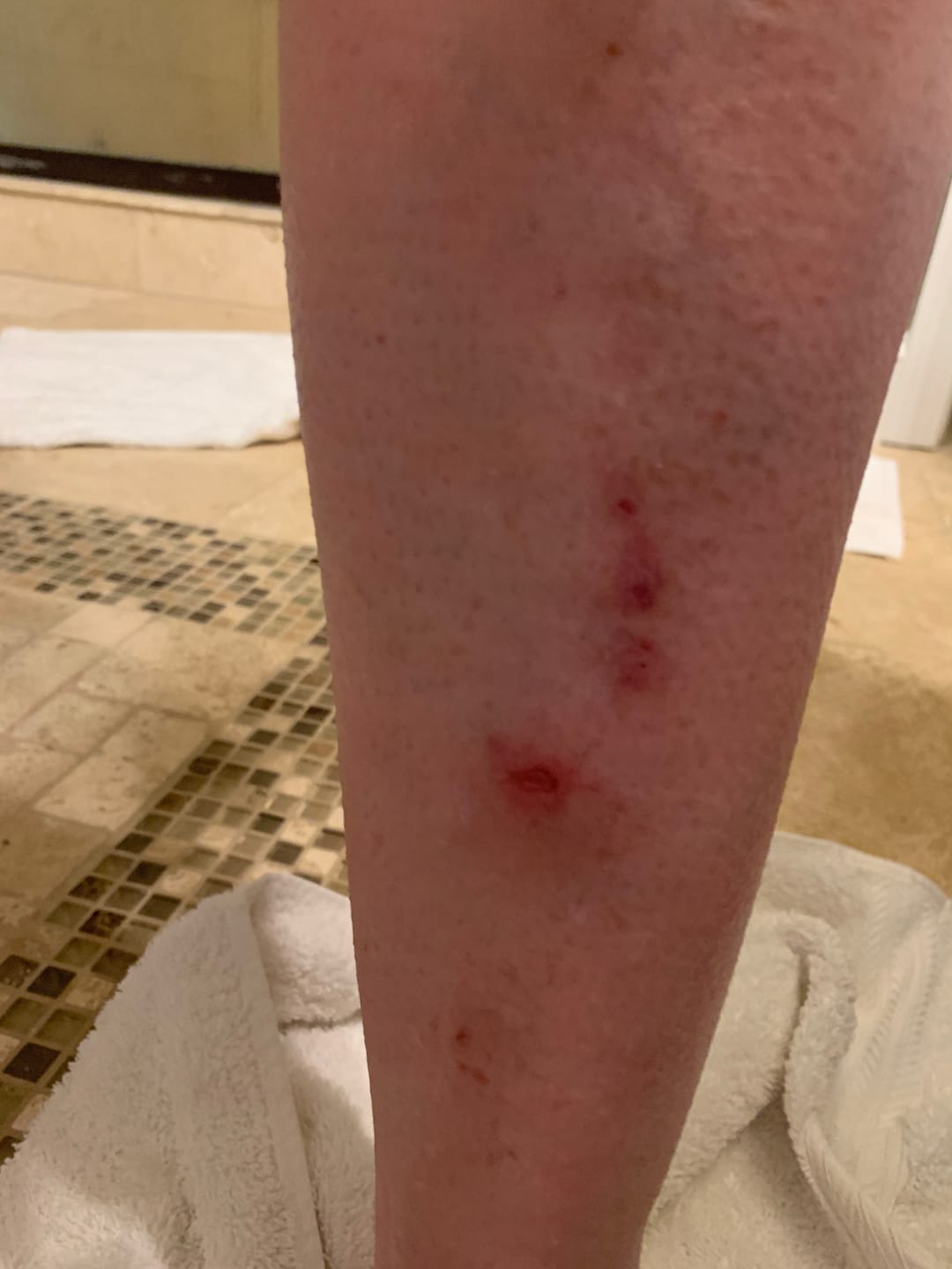Customer photo review of Flatter, Smoother, Calmer Scars in as Little as 3 Days