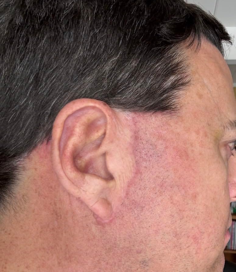Customer photo review of Flatter, Smoother, Calmer Scars in as Little as 3 Days