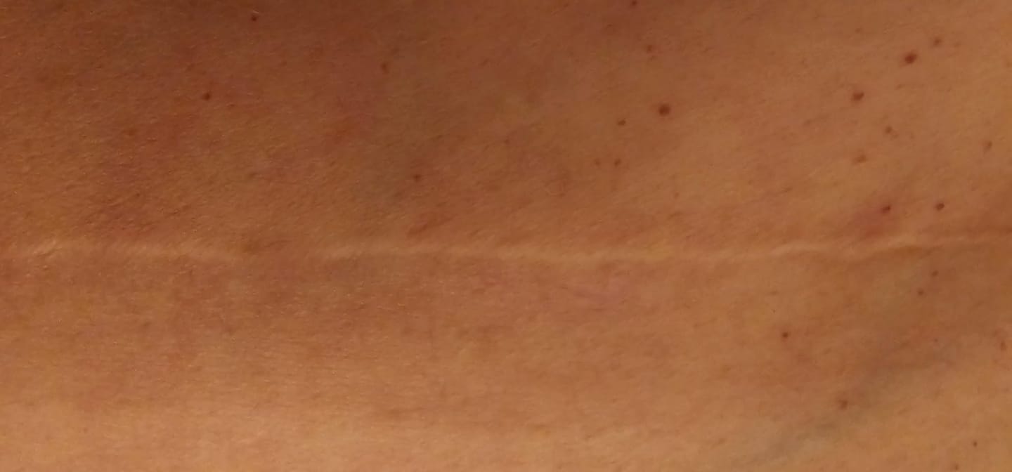 Customer photo review of Flatter, Smoother, Calmer Scars in as Little as 3 Days