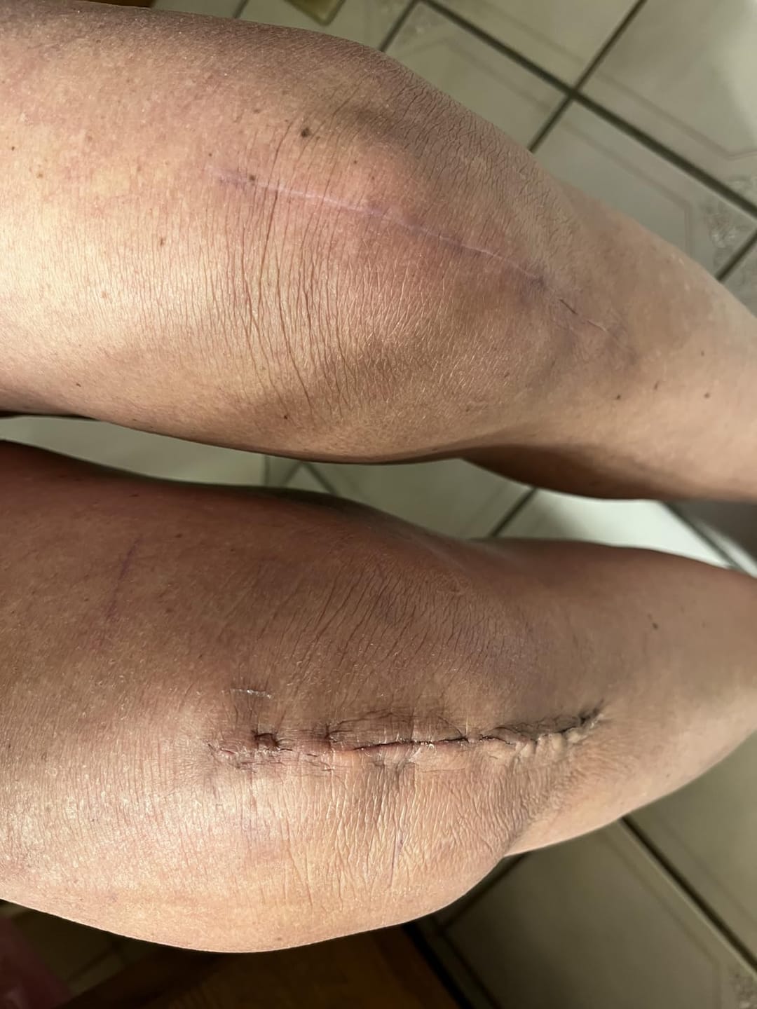 Customer photo review of Flatter, Smoother, Calmer Scars in as Little as 3 Days