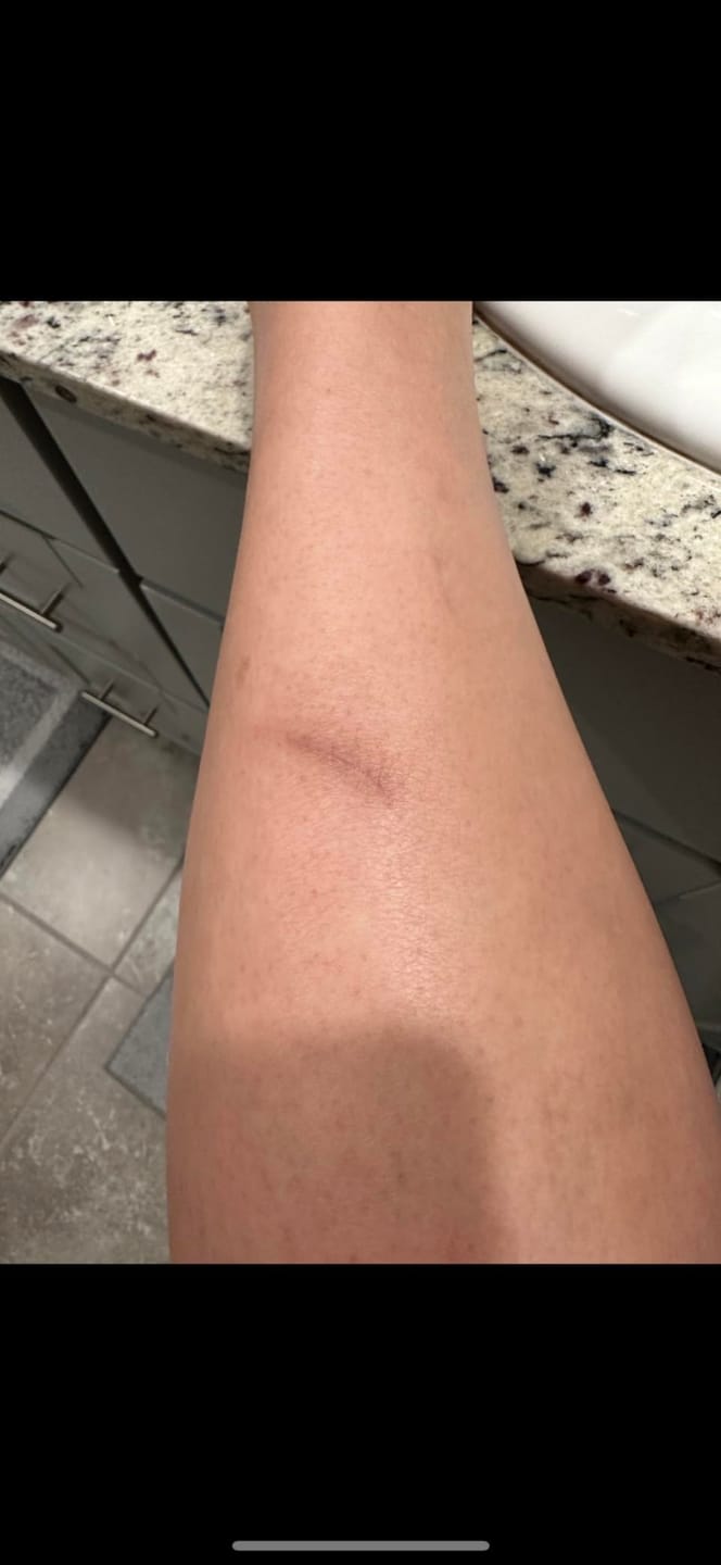 Customer photo review of Flatter, Smoother, Calmer Scars in as Little as 3 Days