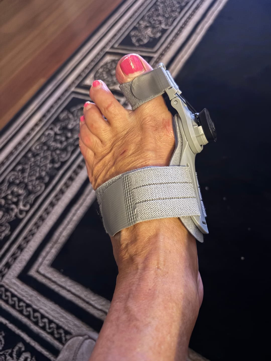 Customer photo review of Treatmedy™ Bunion Fix