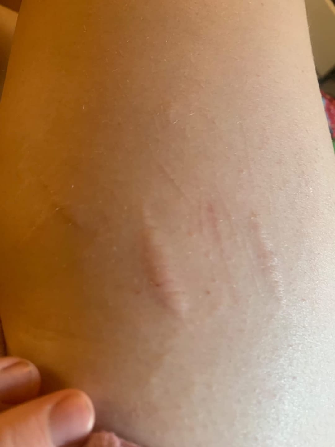 Customer photo review of Flatter, Smoother, Calmer Scars in as Little as 3 Days