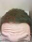 Customer photo review of Regenepure DR Hair & Scalp Treatment Shampoo