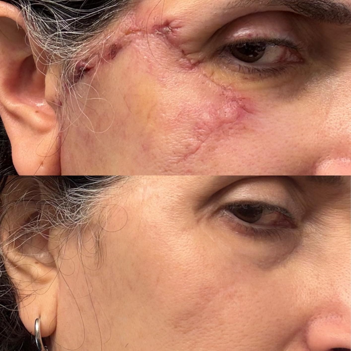 Customer photo review of Flatter, Smoother, Calmer Scars in as Little as 3 Days