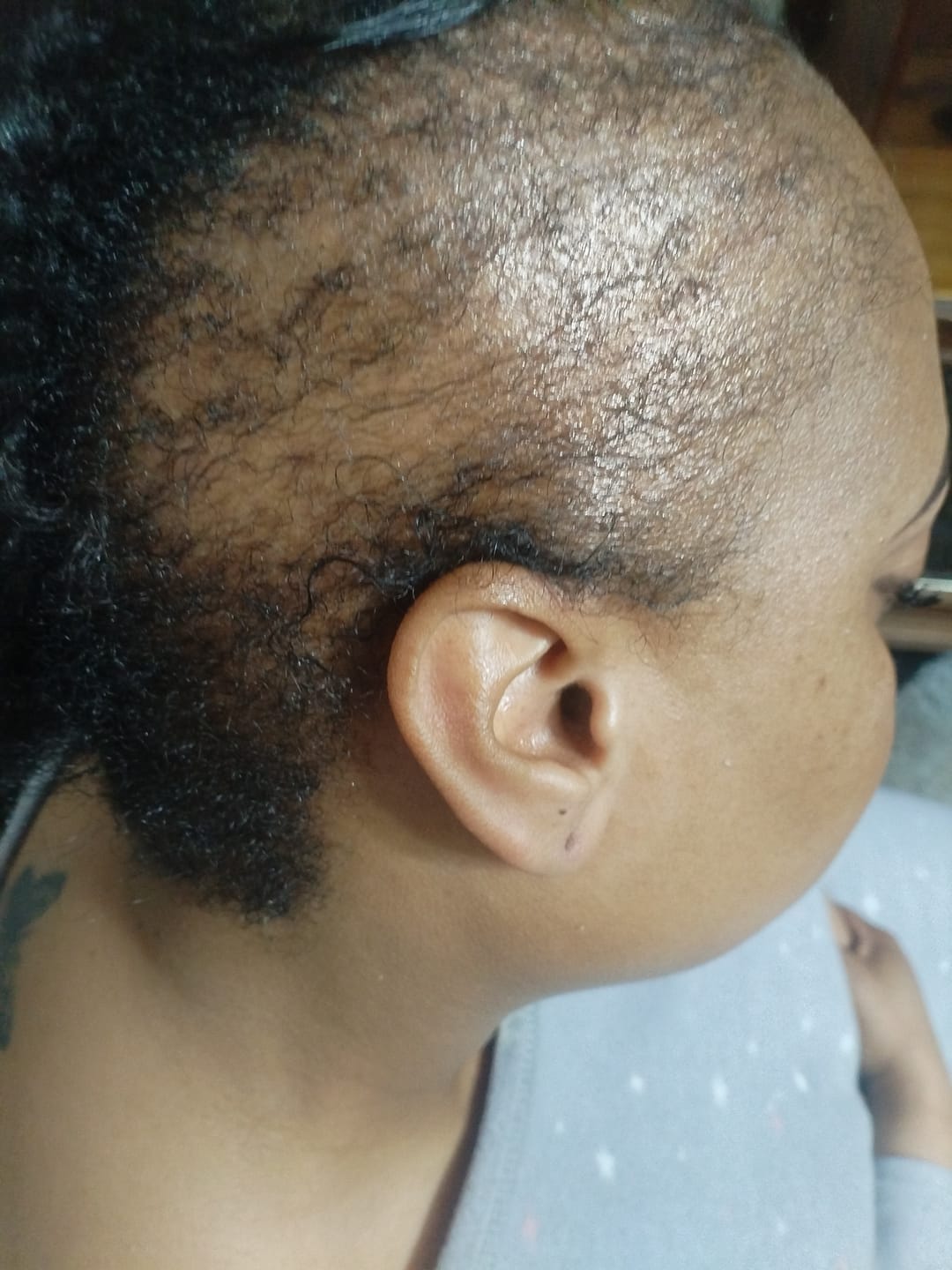 Customer photo review of Minoxidil Root Stimulator (50ml)