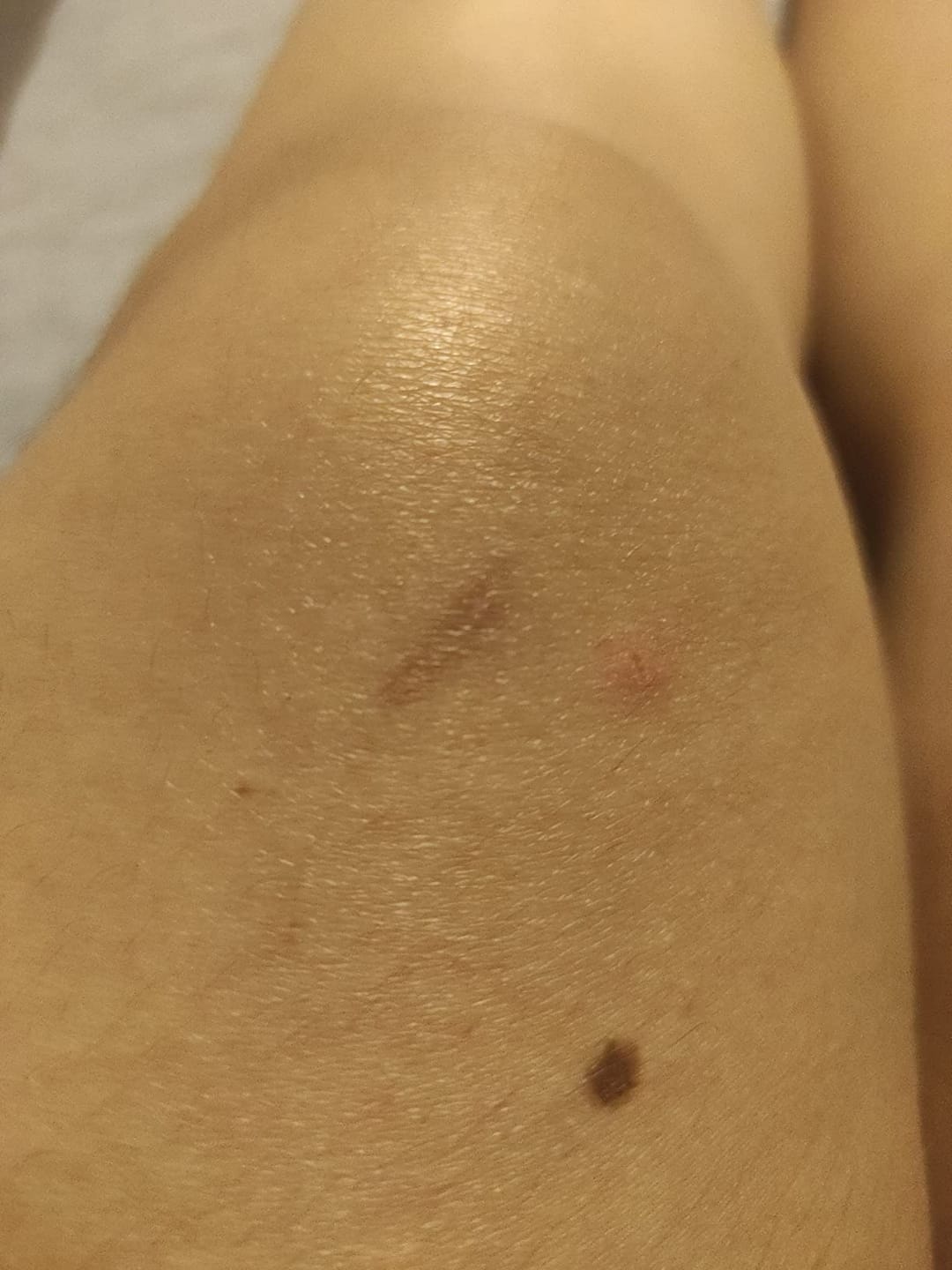 Customer photo review of Flatter, Smoother, Calmer Scars in as Little as 3 Days