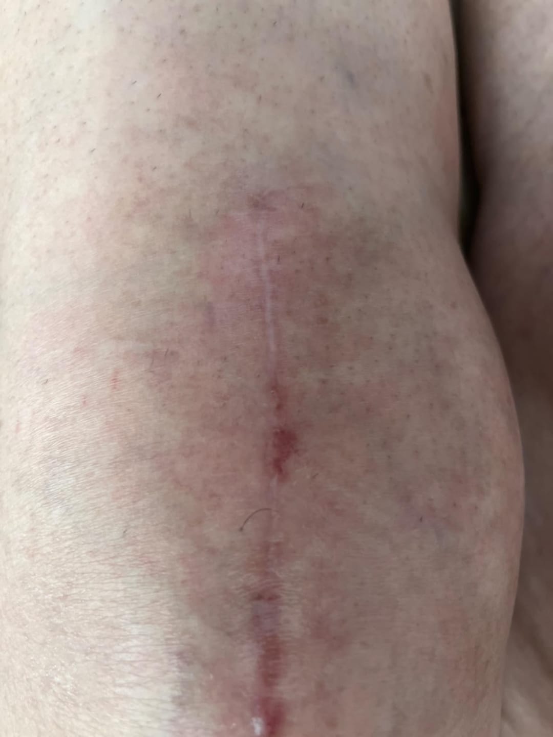 Customer photo review of Flatter, Smoother, Calmer Scars in as Little as 3 Days
