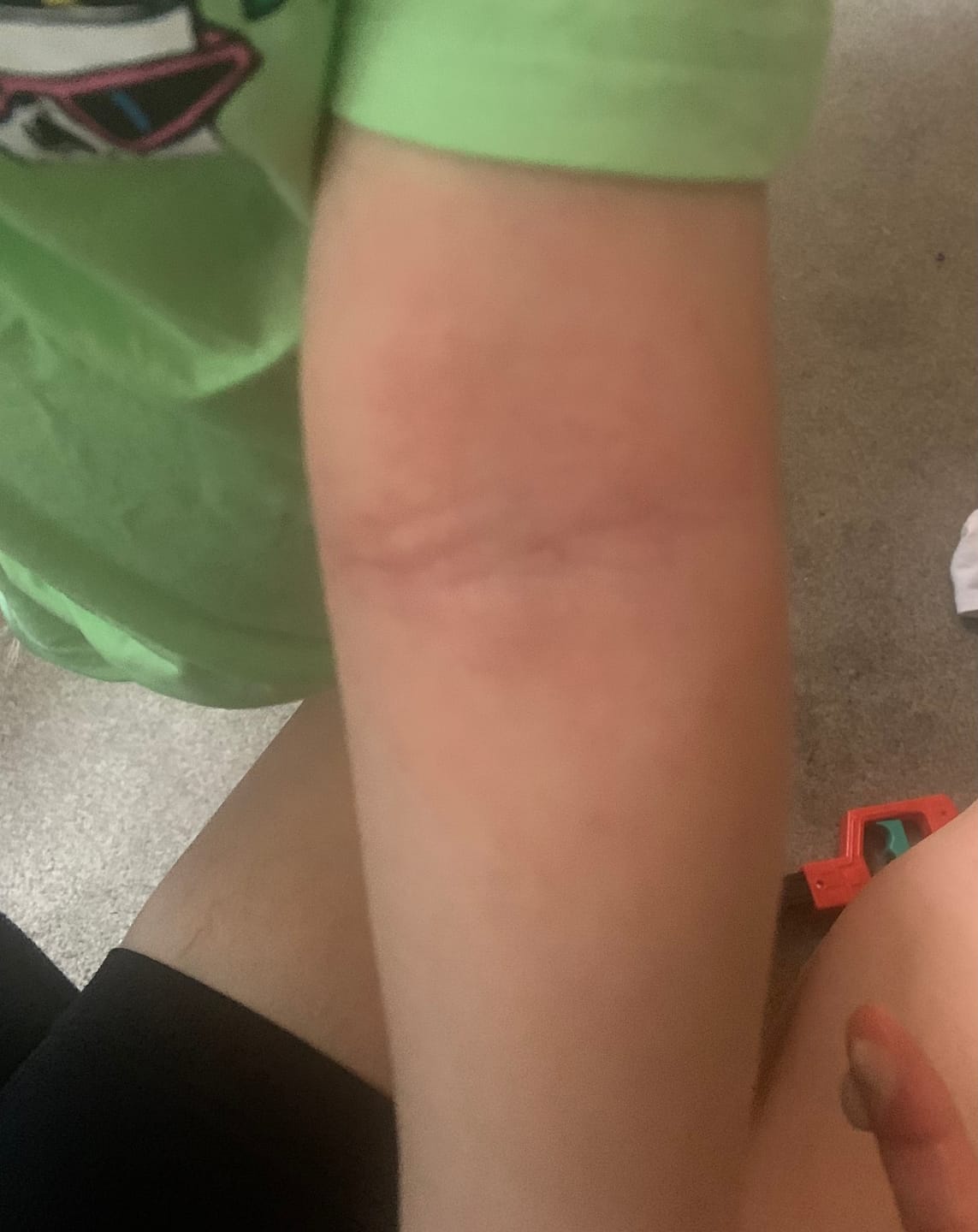 Customer photo review of Bioskin Junior Outbreak Rescue Cream