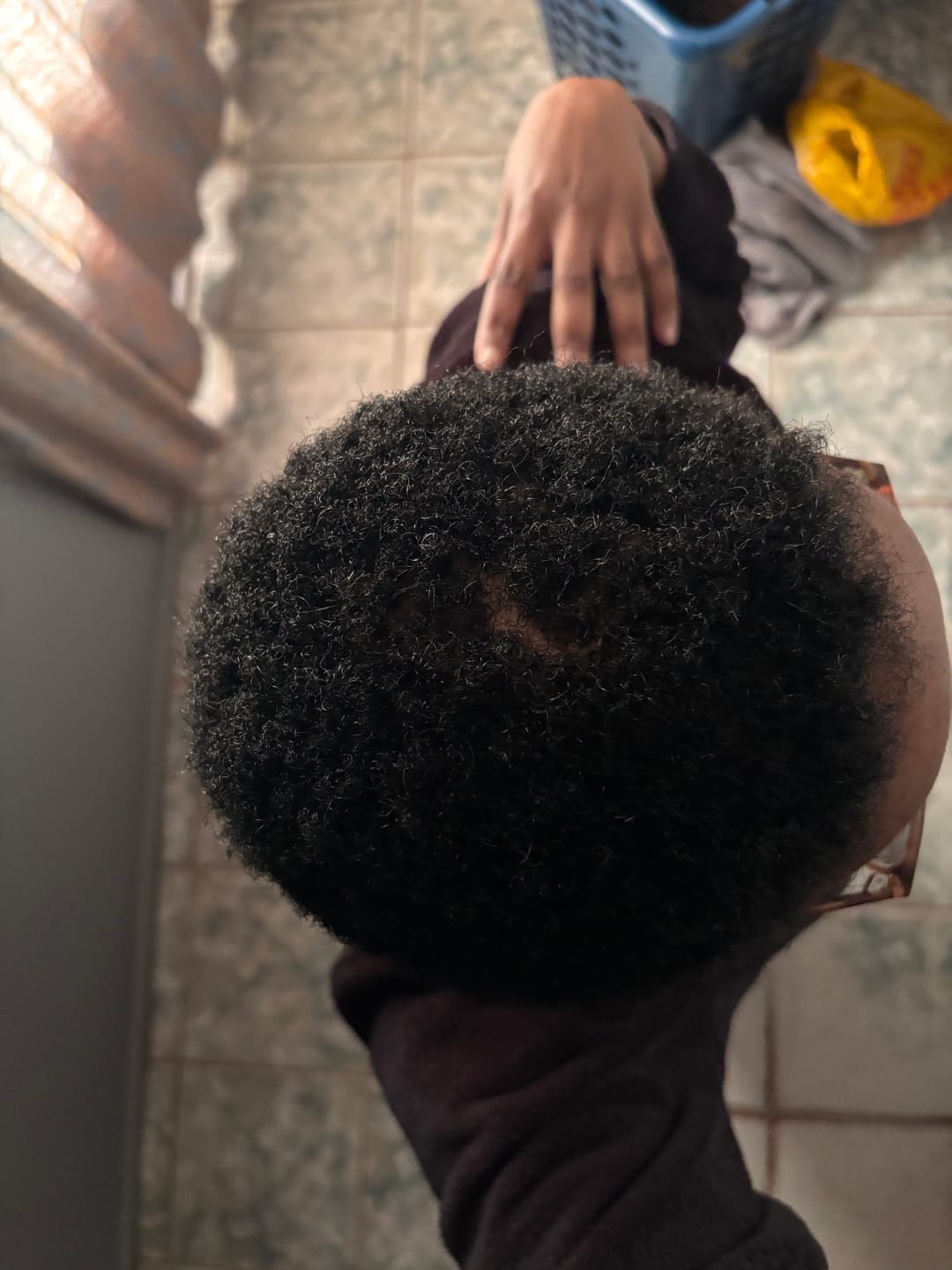 Customer photo review of Scalp Serum Set - Minoxidil