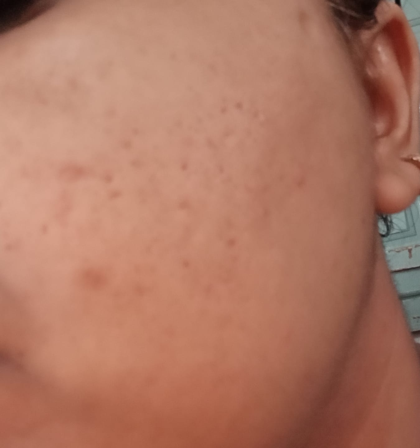 Customer photo review of NiaRonic Serum (Pore Minimizing)