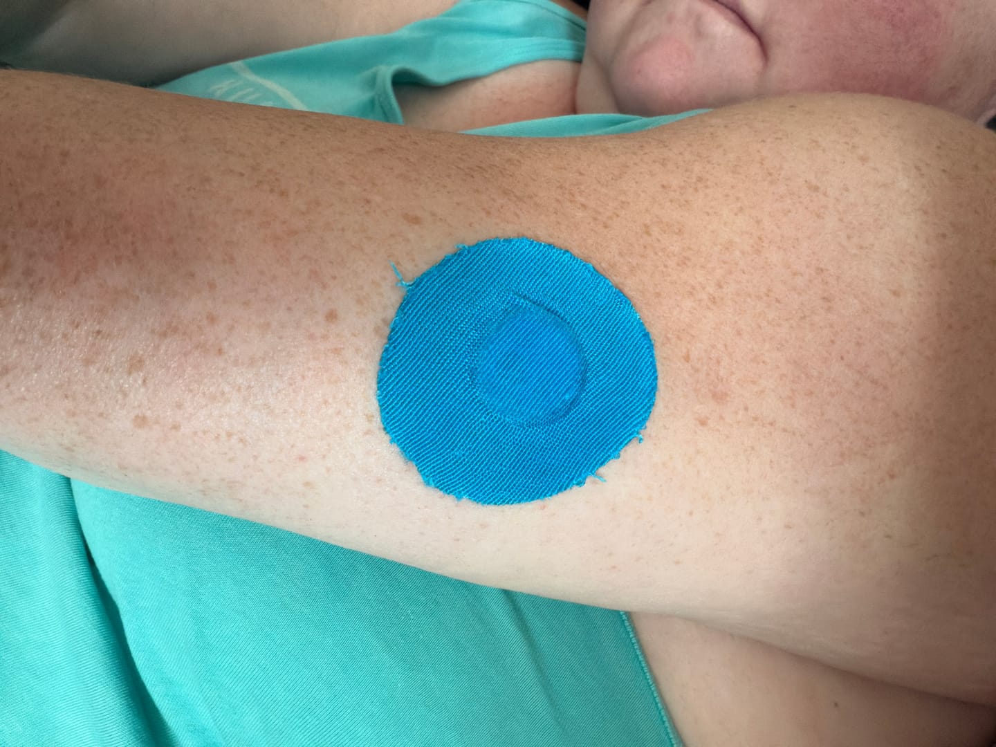 Customer photo review of Skin Grip Original - Libre 3+ Adhesive Patches
