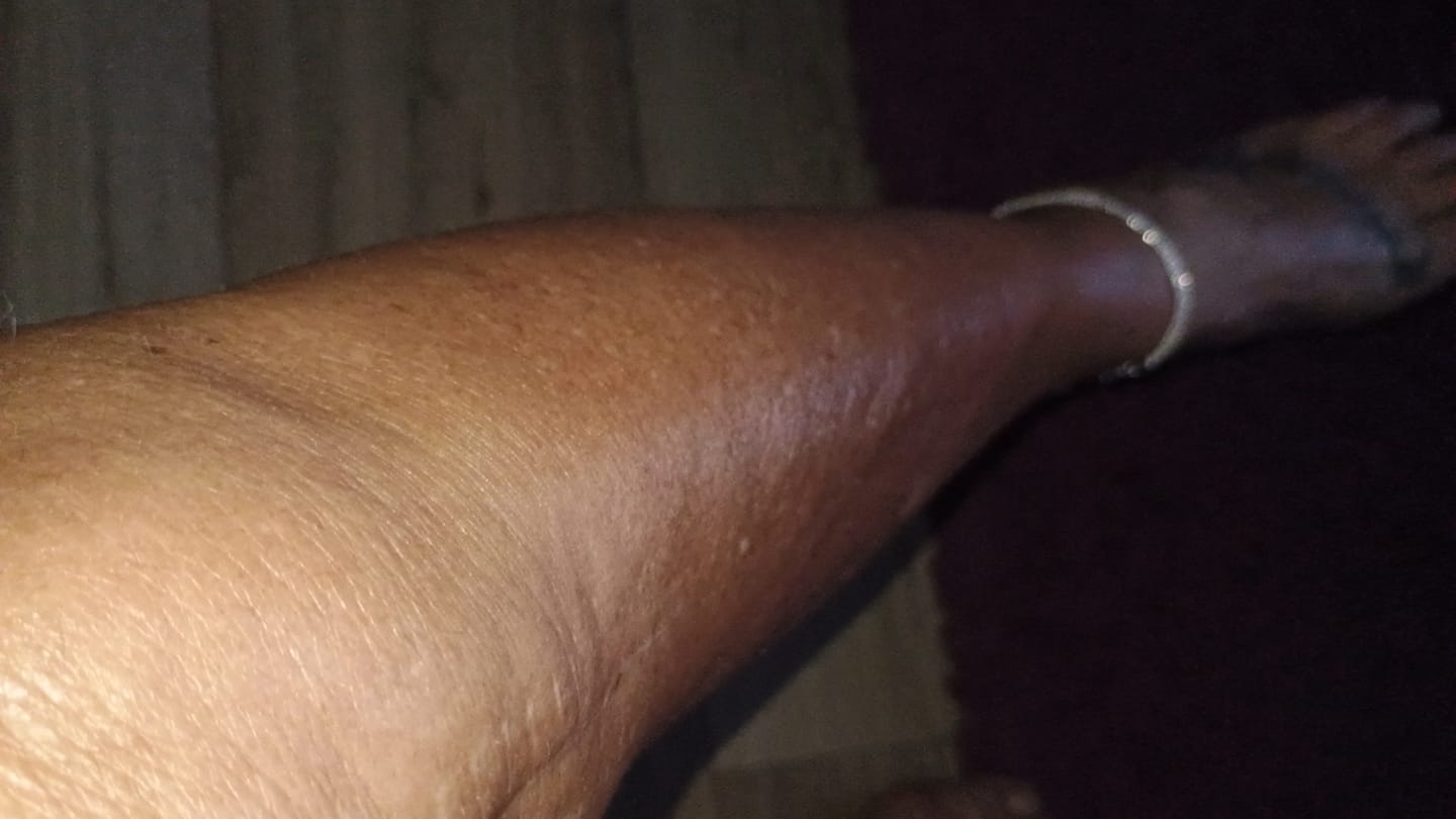 Customer photo review of NØRD BODY Anti-Cellulite Massage Oil