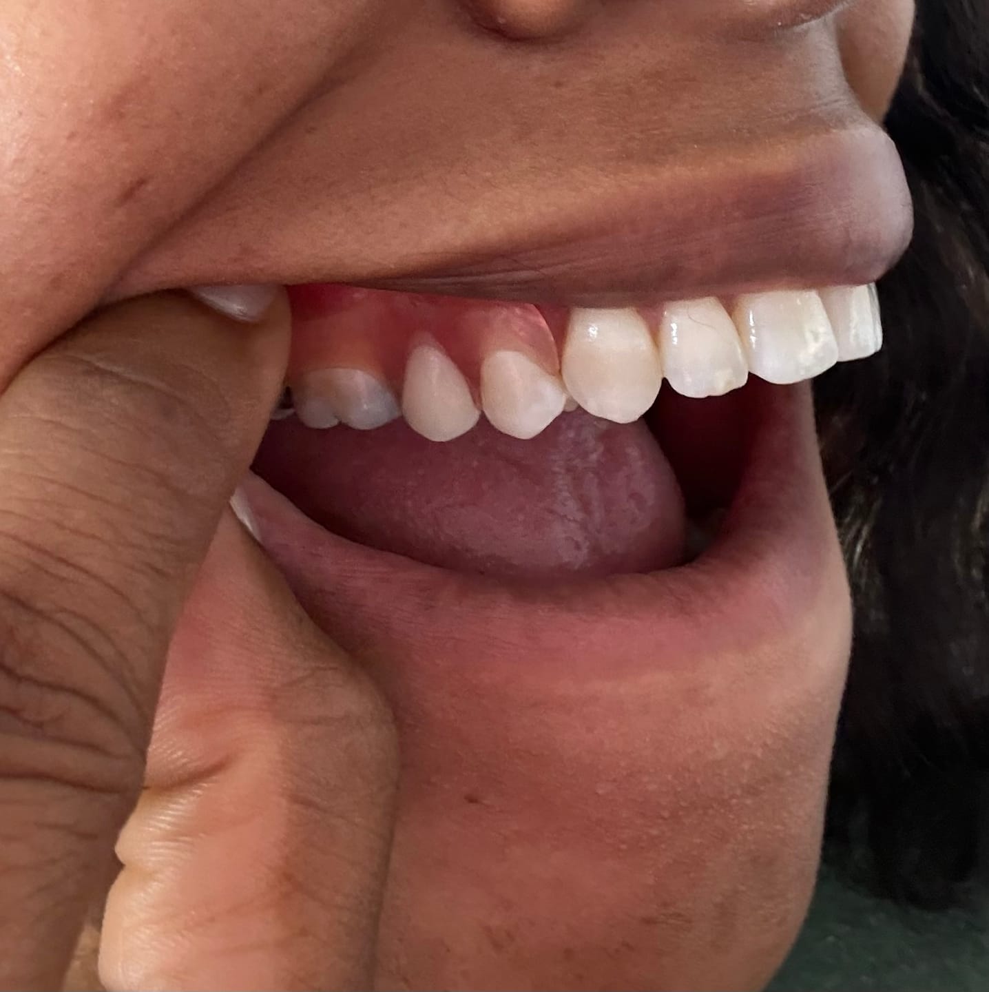 Customer photo review of Unilateral Partial Denture
