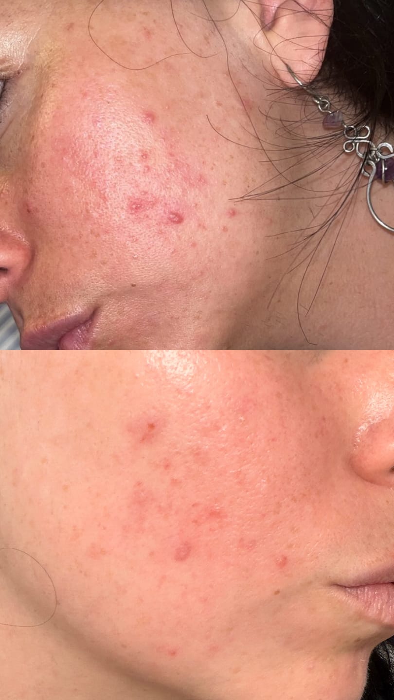 Customer photo review of A CONTROL - ACNÉ HORMONAL & RESISTENCIA A LA INSULINA