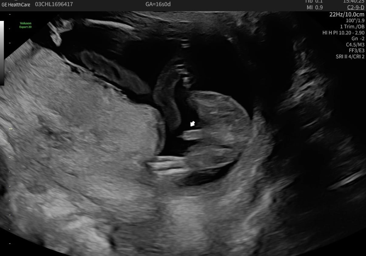 Customer photo review of EarlyReveal Tap DNA Gender Test Over 99% Accurate | Painless & Needle Free