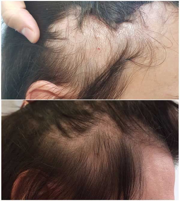 Customer photo review of ערכת צמיחת שיער מחדש
