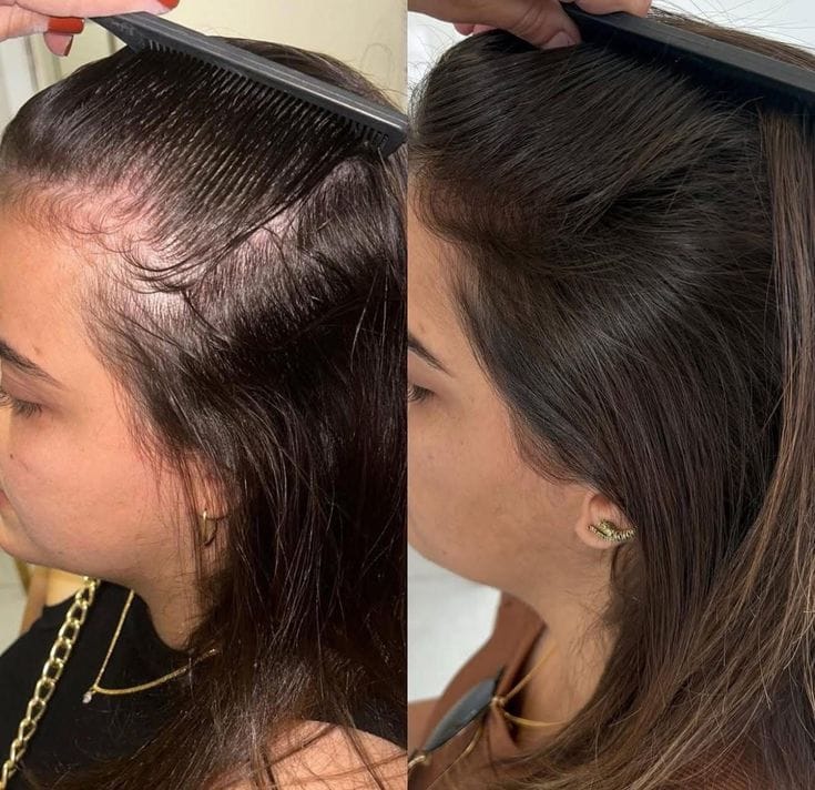 Customer photo review of ערכת צמיחת שיער מחדש