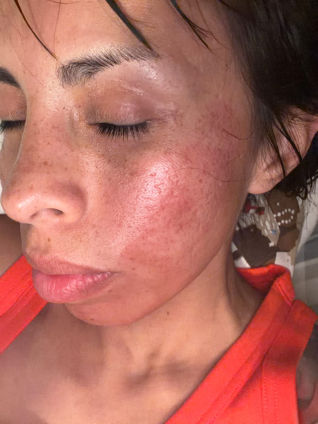 Customer photo review of Dr. Pen Adjustable Derma Stamp Bio Needle 120